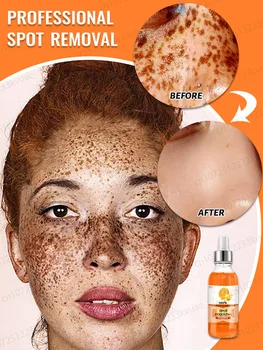 Facial mancha escura de remoção, a proteção do sol, o cloasma, sardas, as manchas de idade remoção, a vitamina C essência